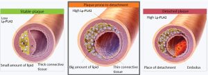 lp-pla2 activity blood test chart showing inflammation in the arteries